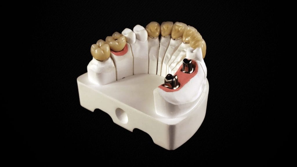 Implant Céramique CAD CAM S.