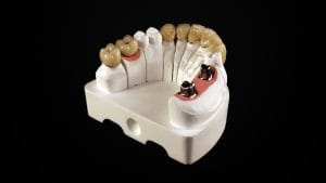 Implant Céramique CAD-CAM S