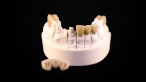 Implants CAD CAM Transvissée. Prothèse dentaire céramique réalisée sur mesure avec le système SIMEDA. Dent en céramique de haute qualité.