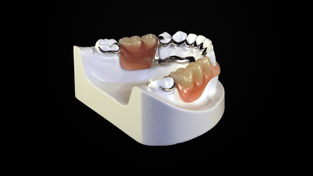 Stellite Valplast Mon Prothésiste